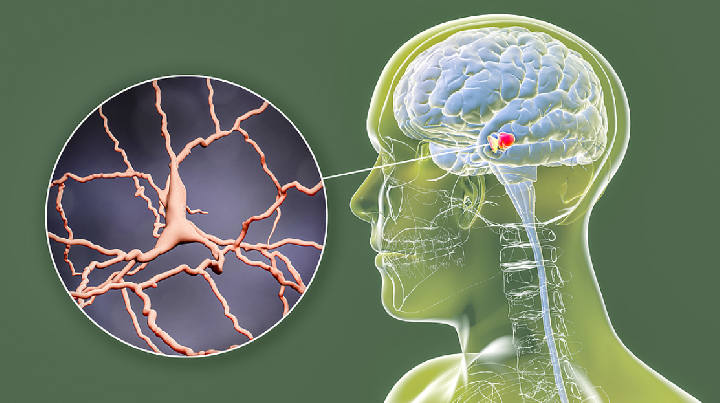 “内外兼修”综治帕金森病