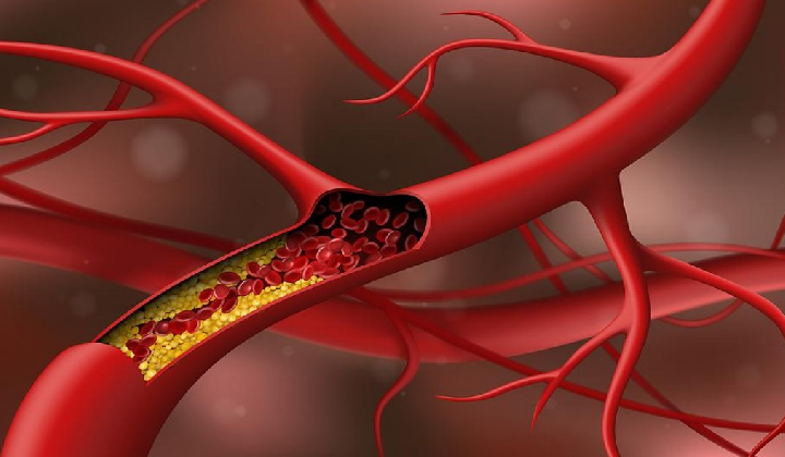 身体出现3类表现，可能是血管变硬了